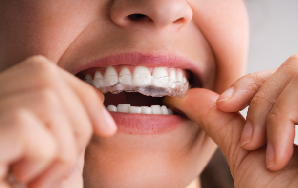 clear-aligners clear-aligners